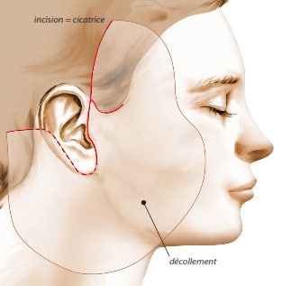 Zone traitée par le lifting cervico-facial