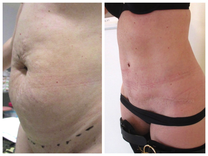 abdominoplastie complète