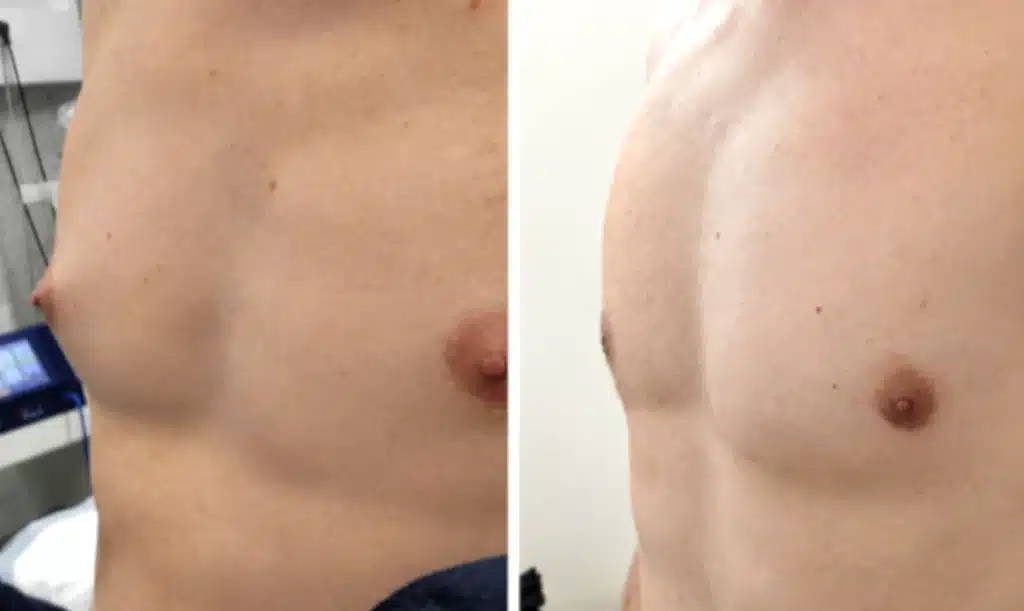 adipomastie corrigée par chirurgie