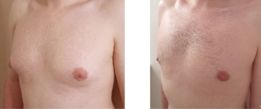 adipomastie traitée par liposuccion