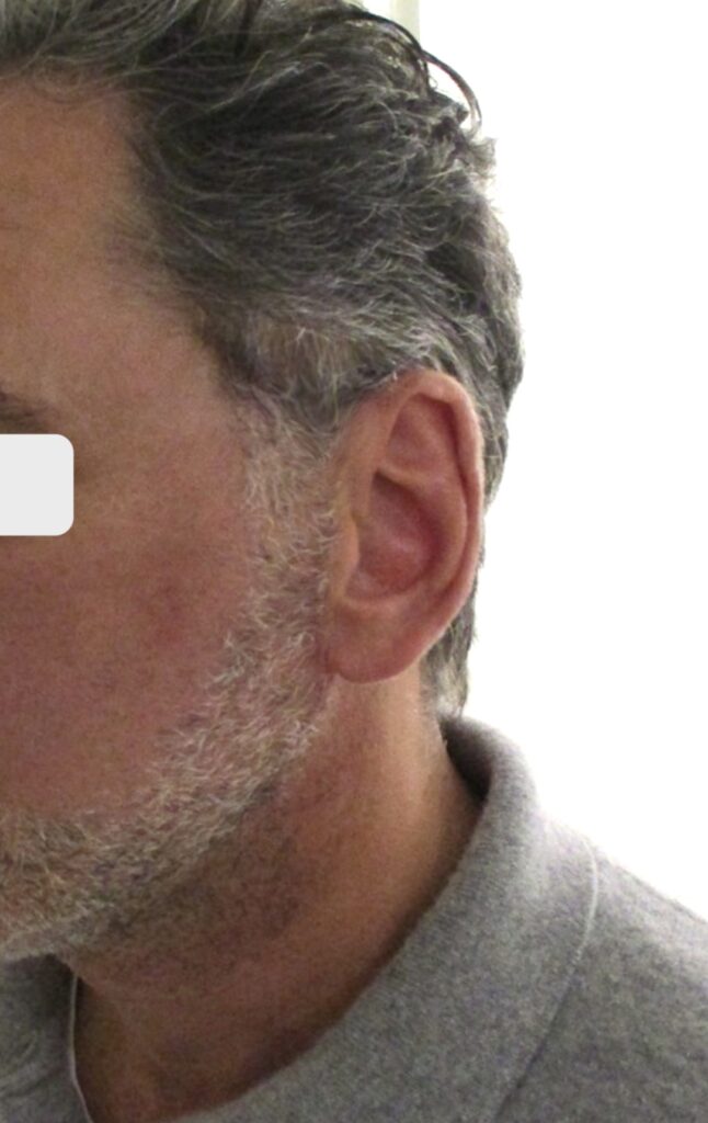 cicatrice lifting cervico-facial homme