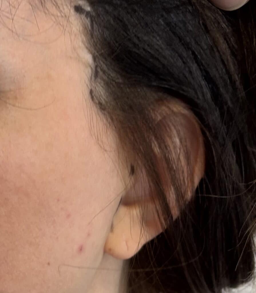 position des cicatrices d'un lifting du visage