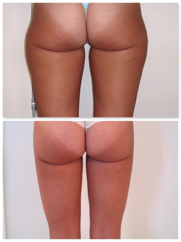 Liposuccion des cuisses et de la culotte de cheval à 6 mois
