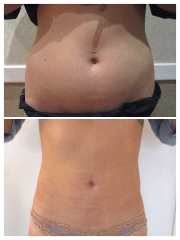 lipoaspiration du ventre et des poignees d'amour pour obtention d'un ventre plat