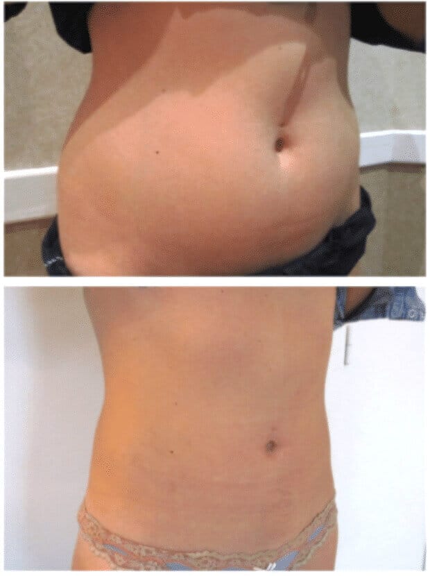 Liposuccion réalisée sur le mode d'esthétique imposant la rédaction d'un devis obligatoire détaillant le prix de l'intervention