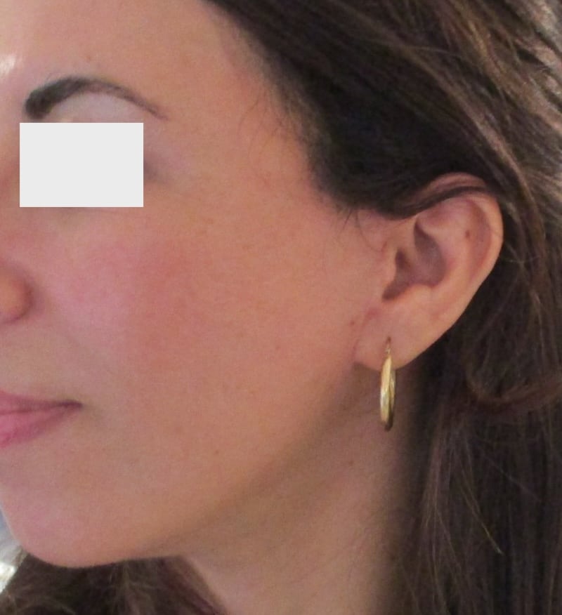 cicatrice lifting cervico-facial 5eme semaine