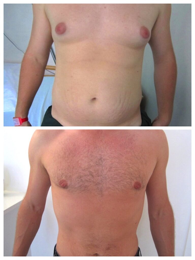 Lipoaspiration du ventre homme, technique classique