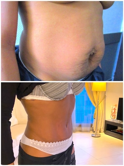 abdominoplastie avec correction de diastasis des muscles grands droits