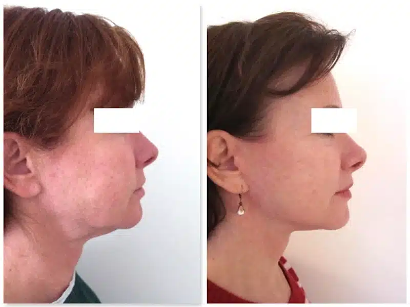 lifting du visage cicatrices matures